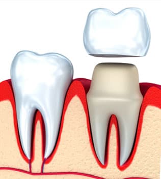 Dental Crowns