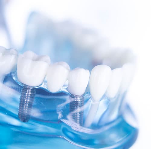 Dental Implants