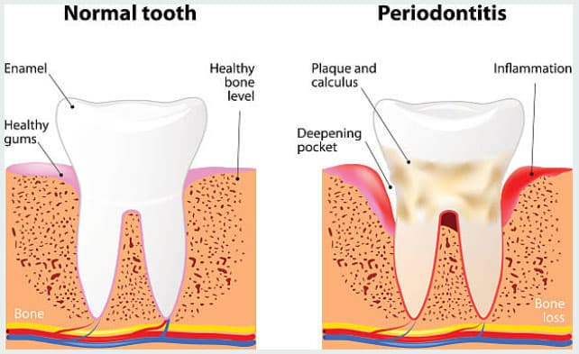 Gum health & fluoride