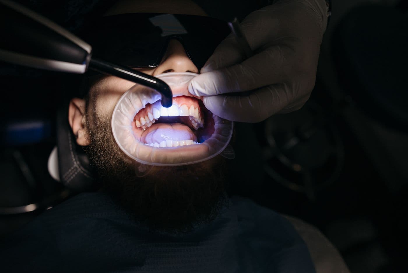 Chipped, cracked & broken teeth
