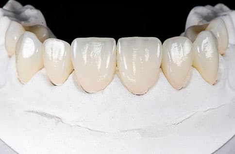 Veneers